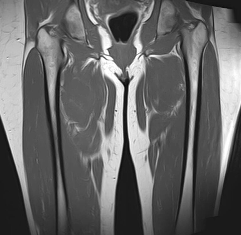 МРТ мягких тканей конечностей