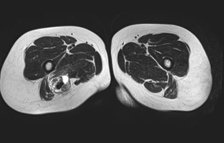 МРТ мягких тканей конечностей