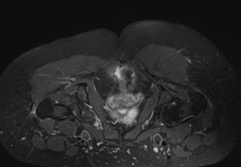 МРТ мягких тканей ягодичной области