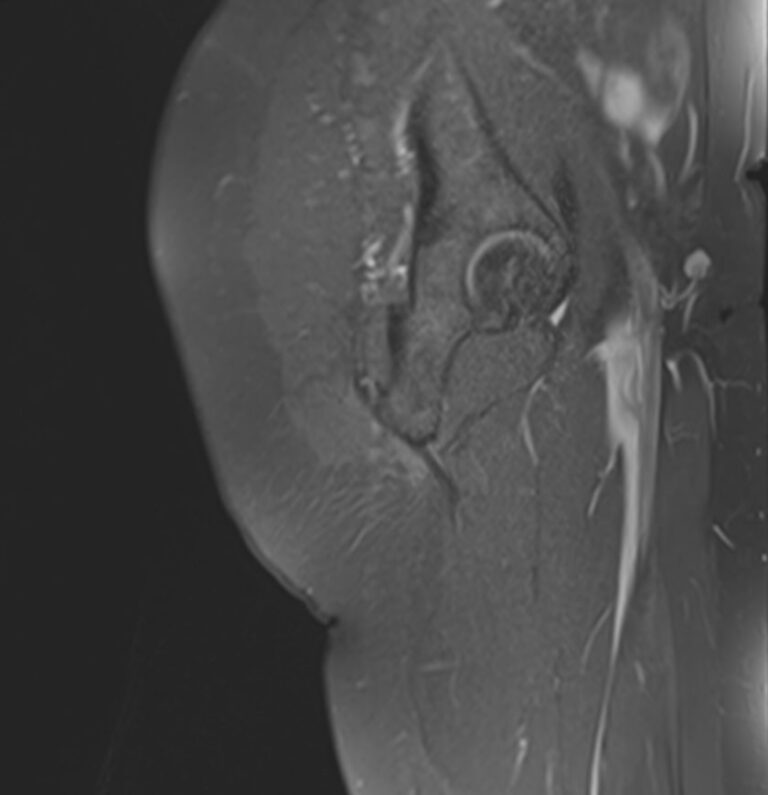 МРТ мягких тканей ягодичной области
