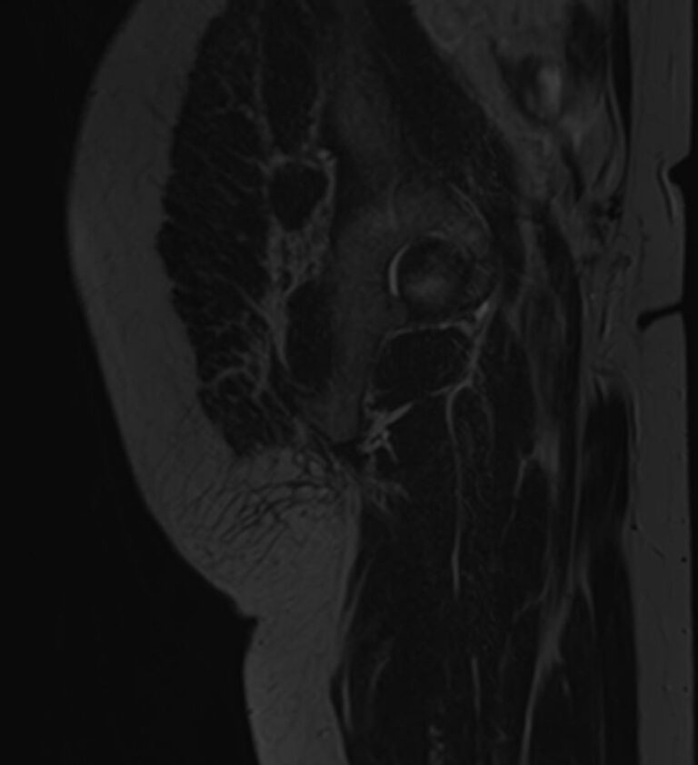МРТ мягких тканей ягодичной области