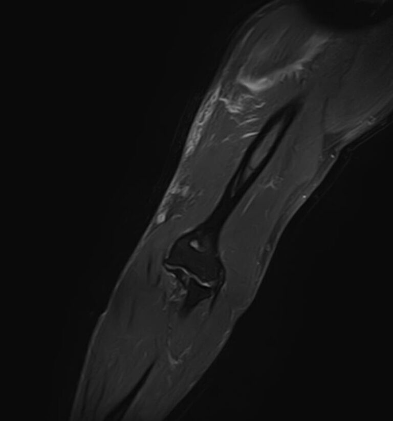 МРТ мягких тканей конечностей