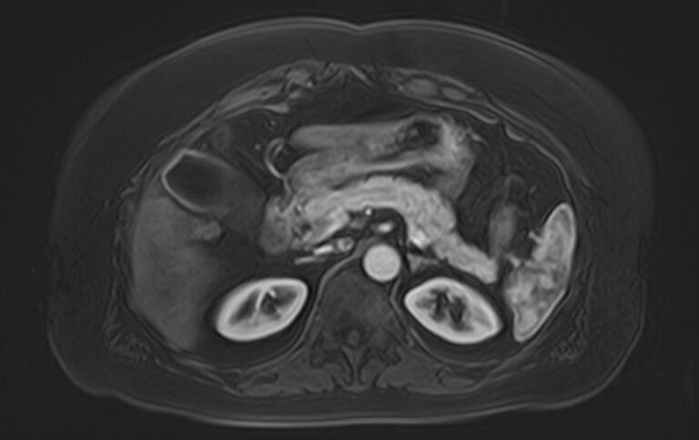 МРТ почек с контрастом