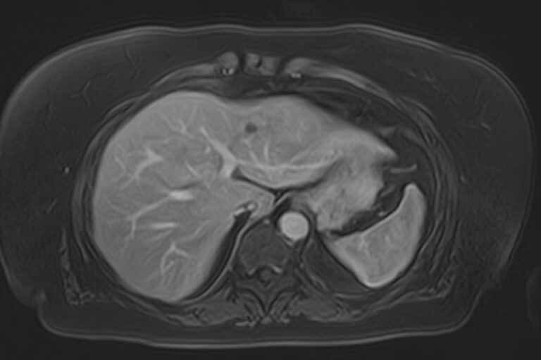 МРТ печени с контрастом