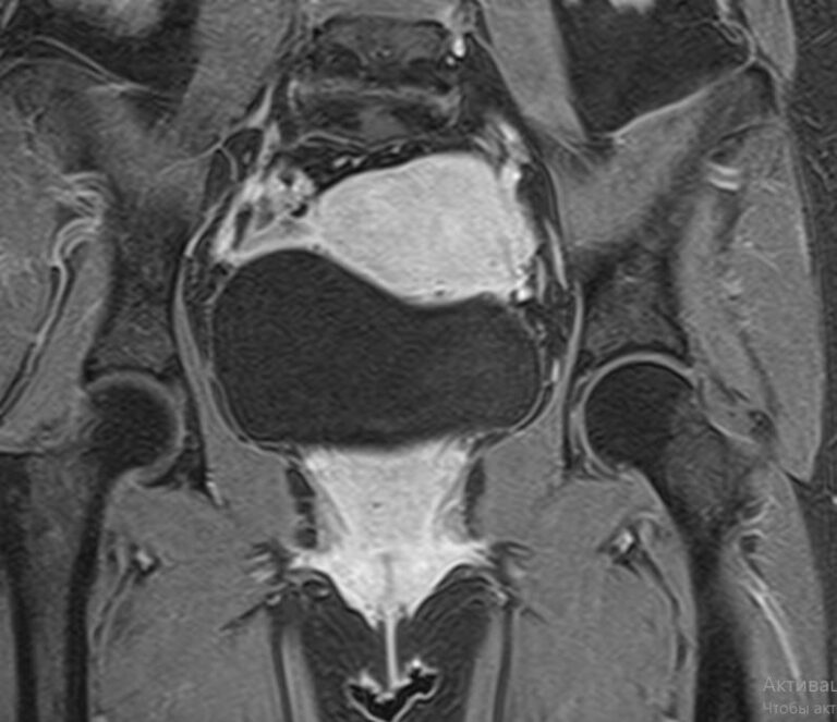 МРТ малого таза с контрастом