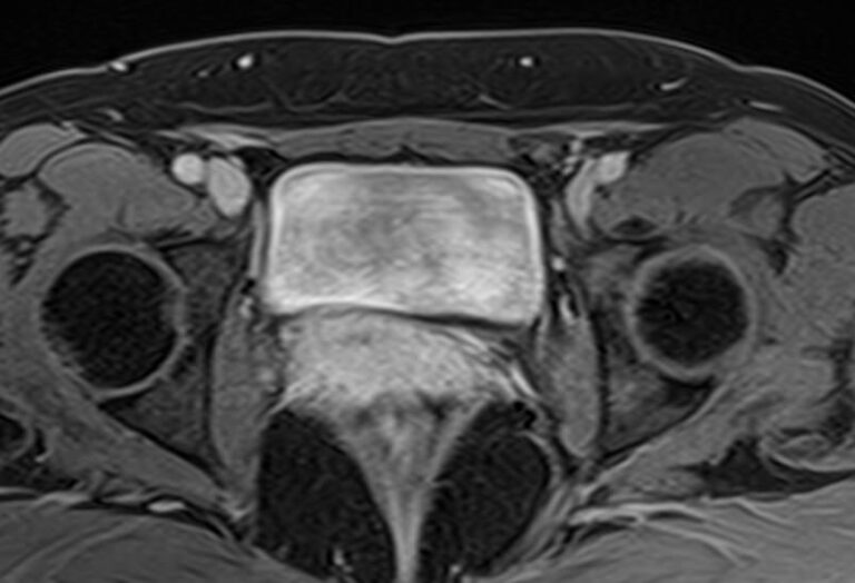 МРТ мочевого пузыря с контрастом