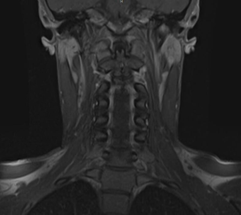МРТ позвоночника с контрастом