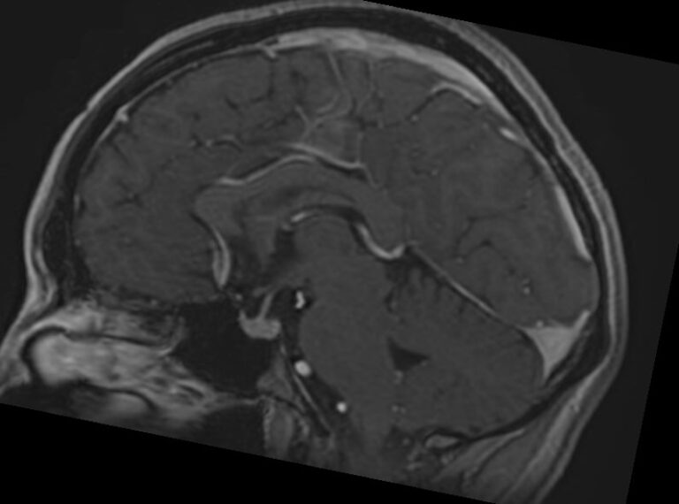 МРТ головного мозга с контрастом