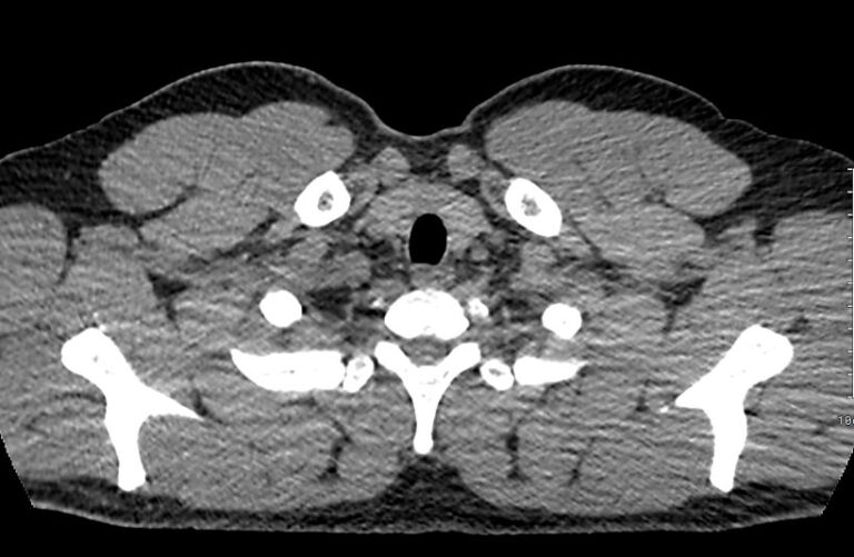 КТ лимфатических узлов средостения, подмышечных, подключичных, надключичных областей