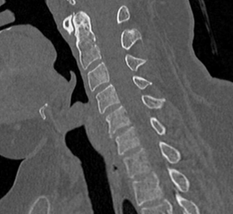КТ трех отделов позвоночника