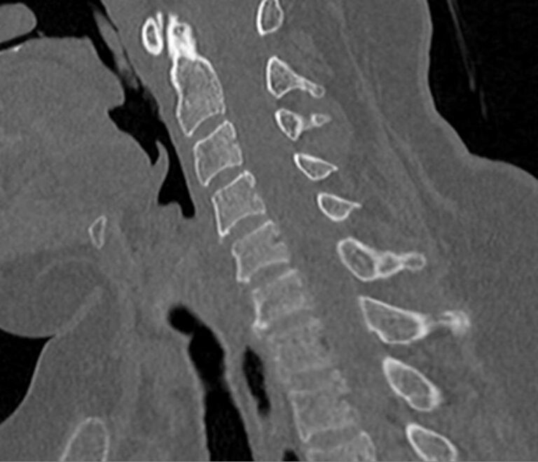 КТ двух отделов позвоночника