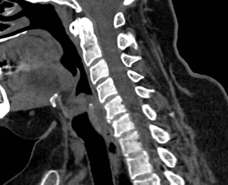 КТ двух отделов позвоночника