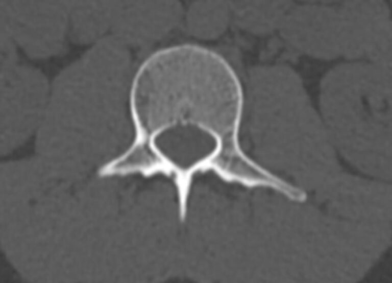 КТ всего позвоночника