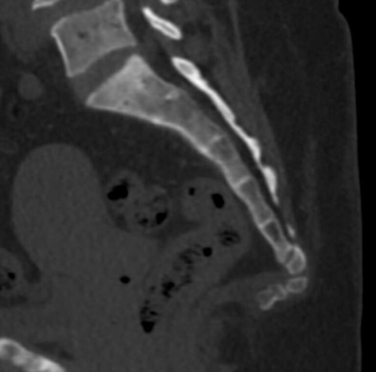 КТ всего позвоночника