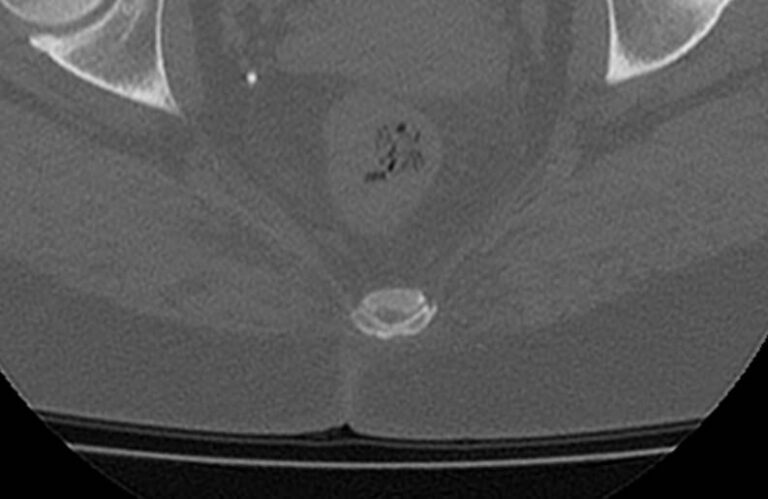 КТ всего позвоночника