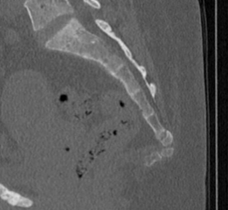 КТ всего позвоночника