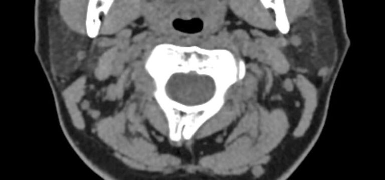 КТ краниовертебрального перехода