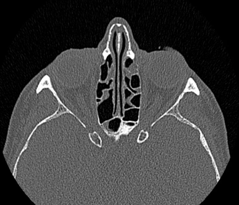 КТ придаточных пазух носа