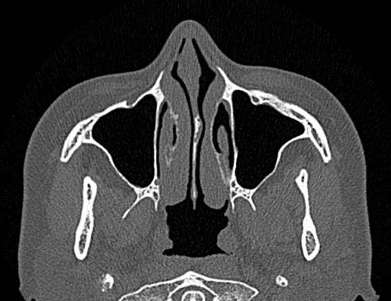 КТ придаточных пазух носа