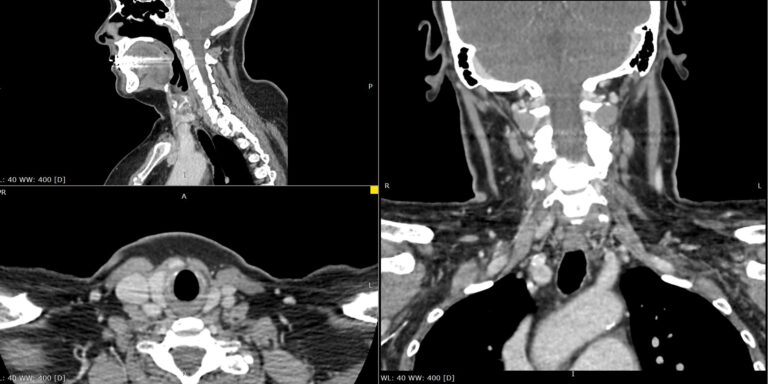 КТ паращитовидных желез