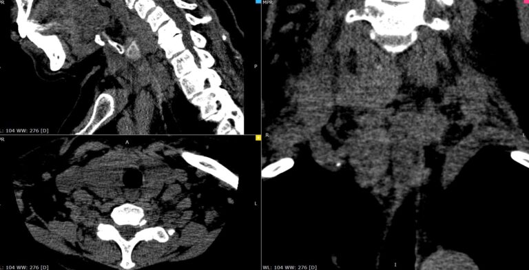 КТ паращитовидных желез