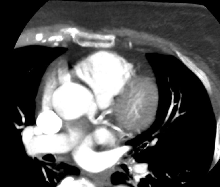 КТ коронарных артерий