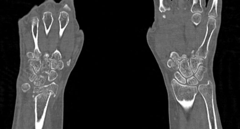 КТ запястья