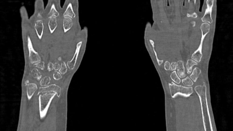 КТ запястья