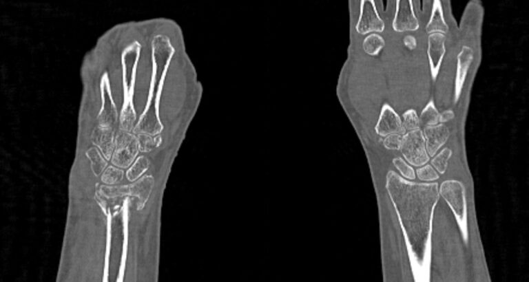 КТ запястья