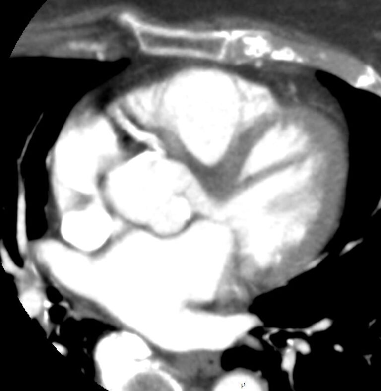 КТ коронарных артерий