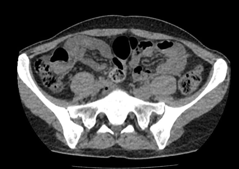 КТ лимфатических узлов таза и подвздошных областей
