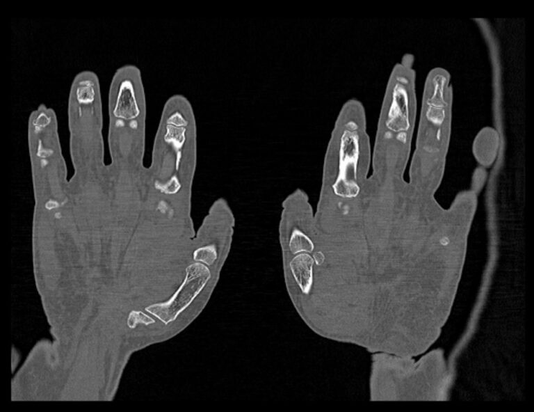 КТ пальцев рук