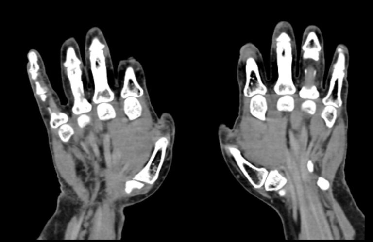 КТ пальцев рук