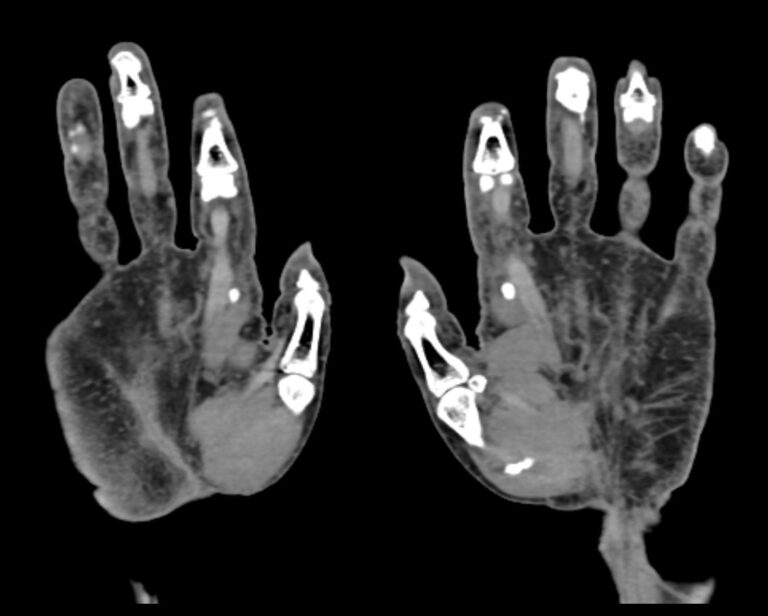 КТ пальцев рук