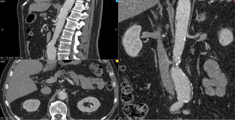 КТ чревного ствола