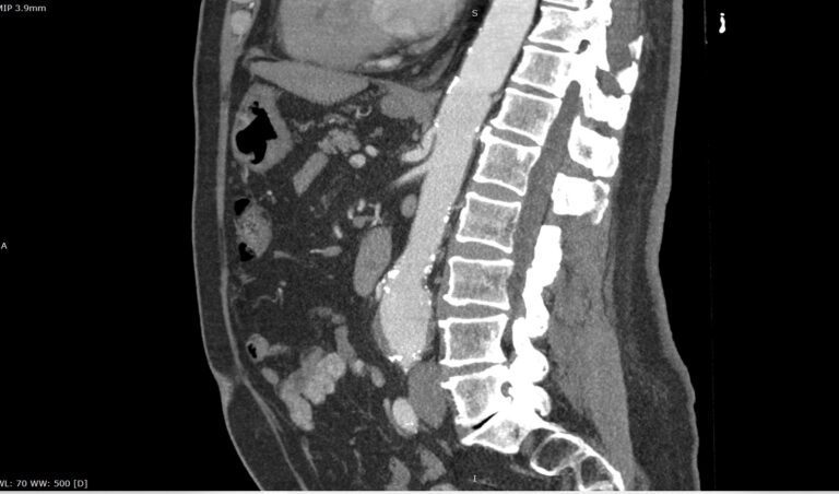 КТ чревного ствола