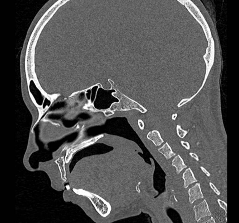 КТ мягких тканей лица