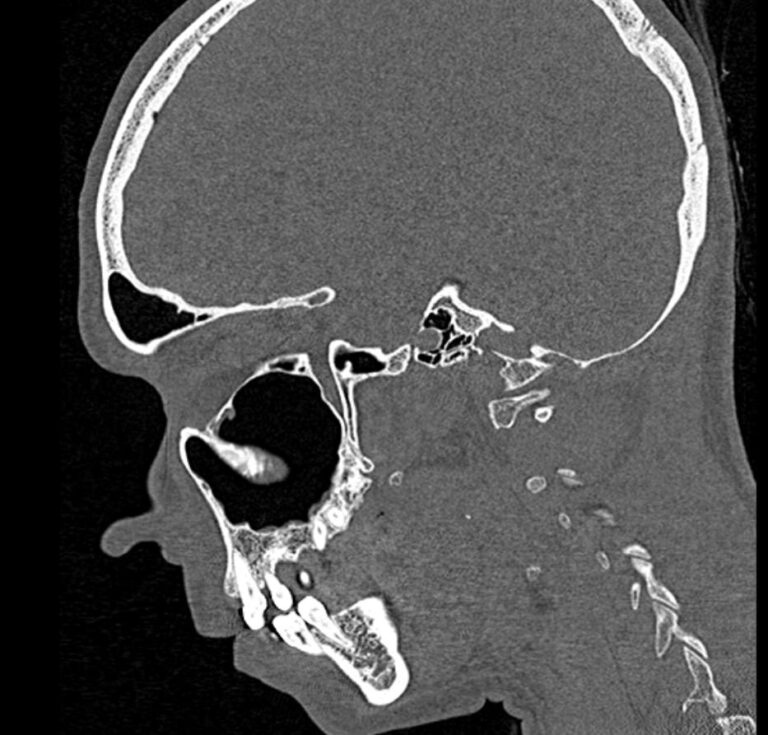 КТ мягких тканей лица