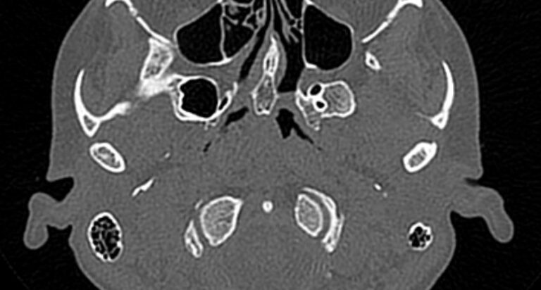 КТ височно-нижнечелюстных суставов