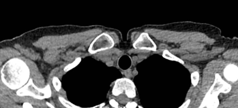 КТ грудино-ключичных сочленений