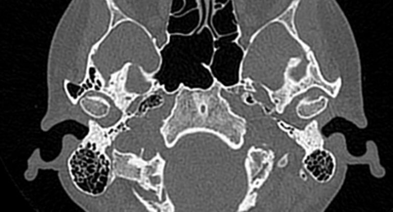 КТ височно-нижнечелюстных суставов