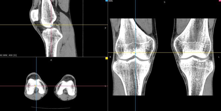 КТ мягких тканей конечностей