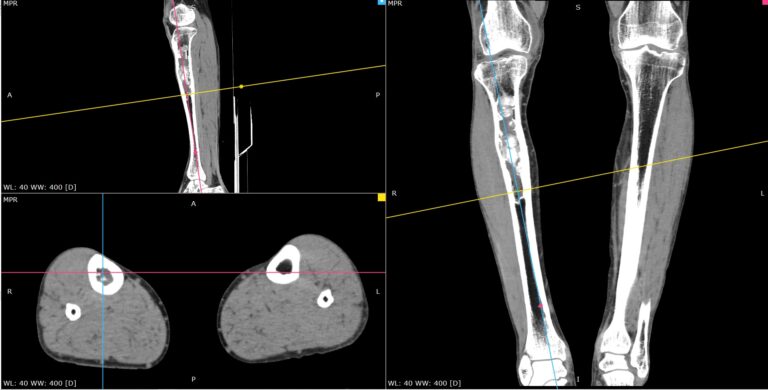 КТ мягких тканей конечностей