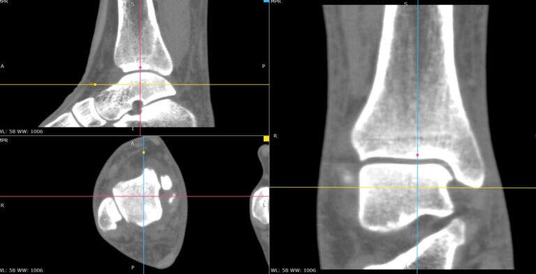 КТ мягких тканей конечностей
