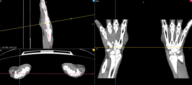 КТ мягких тканей конечностей