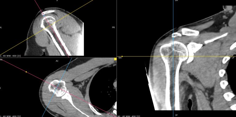 КТ мягких тканей конечностей