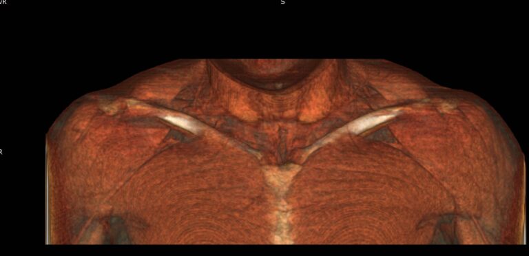 КТ мягких тканей конечностей