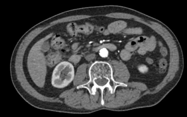 КТ брюшного отдела аорты и артерий нижних конечностей