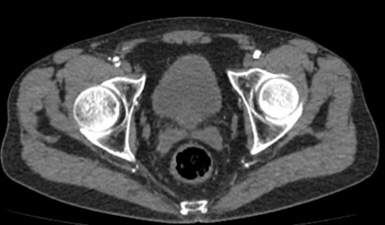 КТ брюшного отдела аорты и артерий нижних конечностей