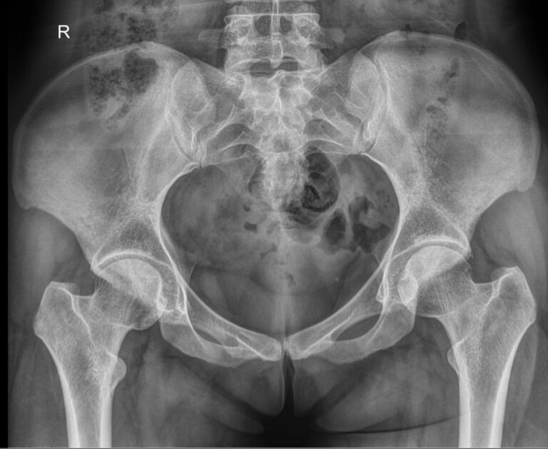 Рентген костей таза